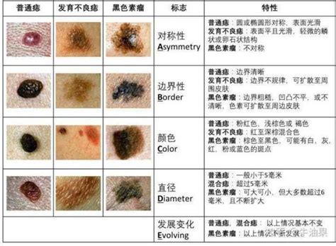 內痣是什麼|痣是什麼？會變成黑色素瘤？7種一定要除的痣